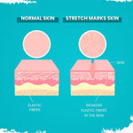 Gynocup Stretch Mark Removal Oil