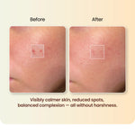 Moha: Spot Corrector Gel for Active Acne (20g) - Pimple Clearing & Active Acne Spot Treatment