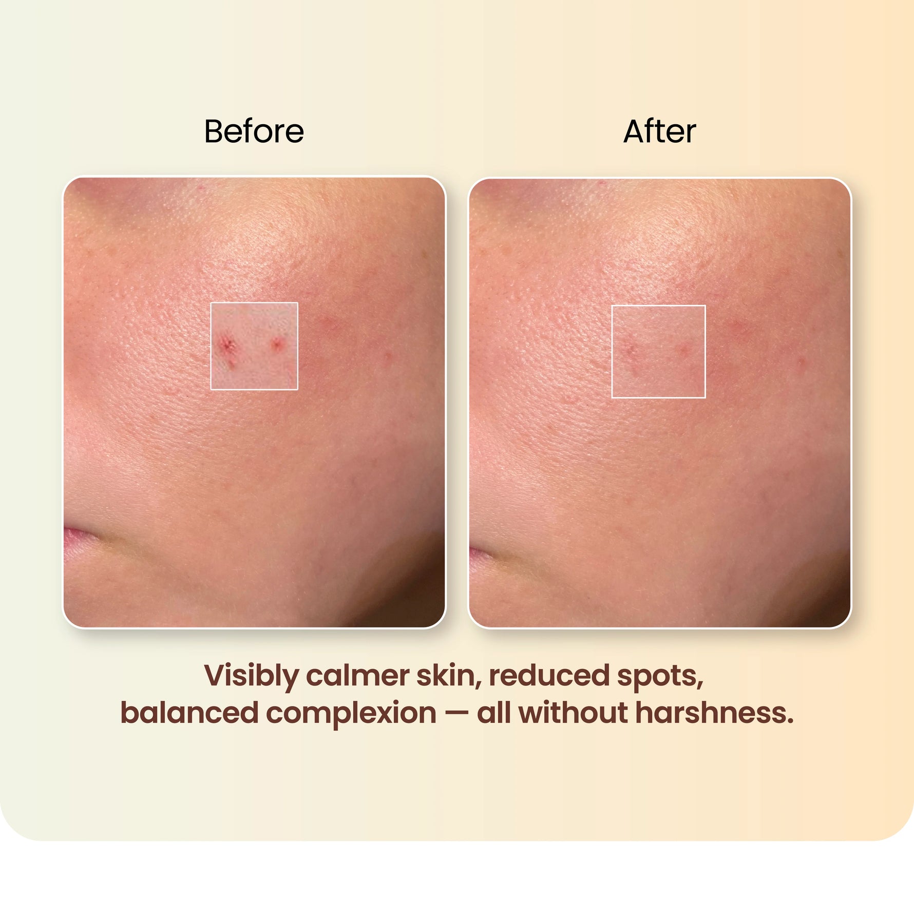 Moha: Spot Corrector Gel for Active Acne (20g) - Pimple Clearing & Active Acne Spot Treatment