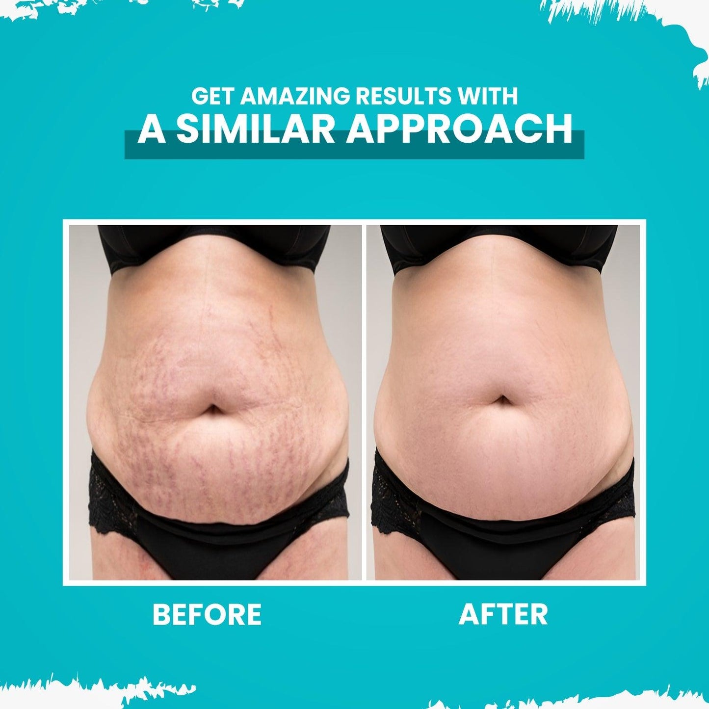 Gynocup Stretch Mark Removal Oil