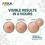 Arka Pure Life Acne Pimple Patch – Hydrocolloid Spot Patches for Blemish & Pimple Care – 36 Dots, 1 Sheet
