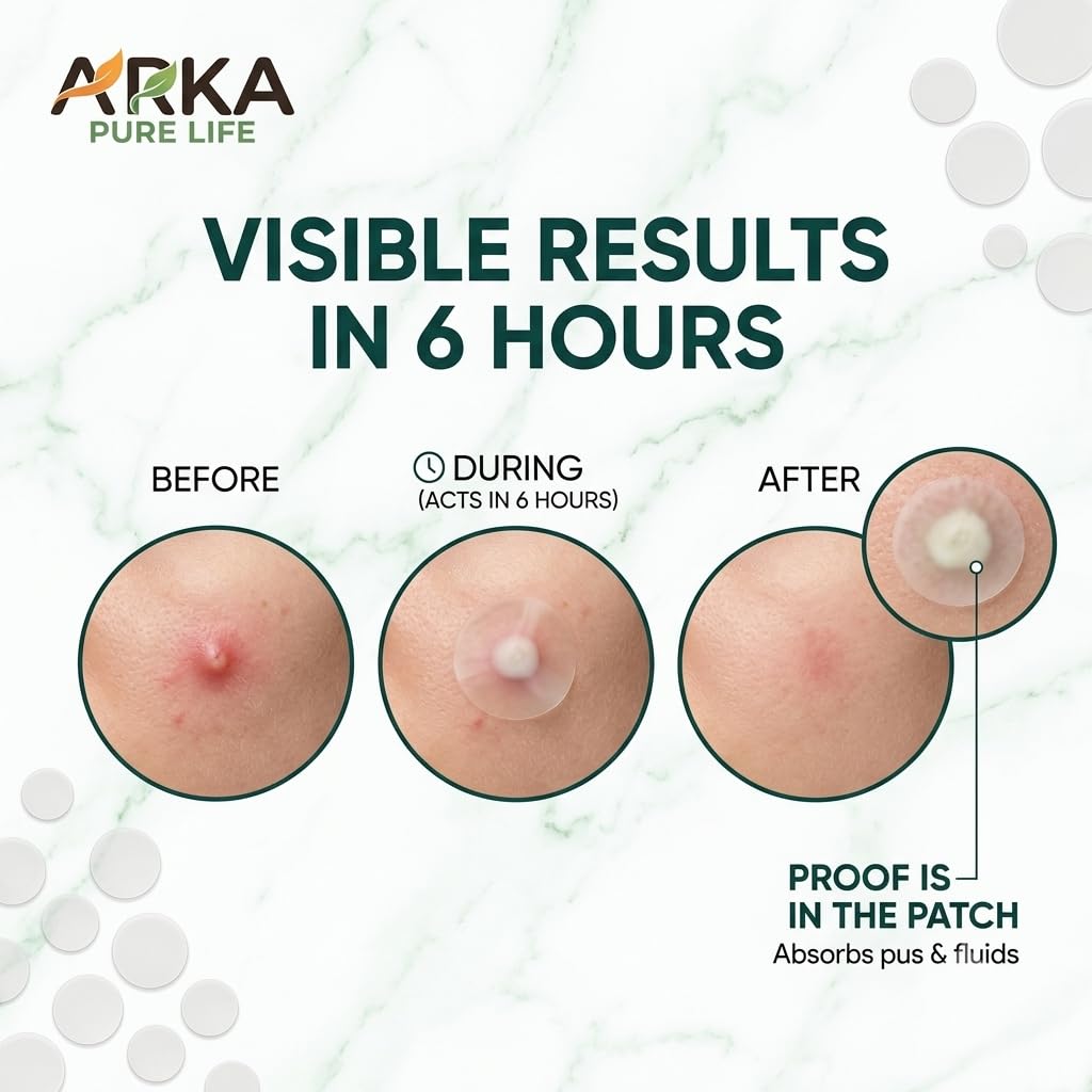 Arka Pure Life Acne Pimple Patch – Hydrocolloid Spot Patches for Blemish & Pimple Care – 36 Dots, 1 Sheet