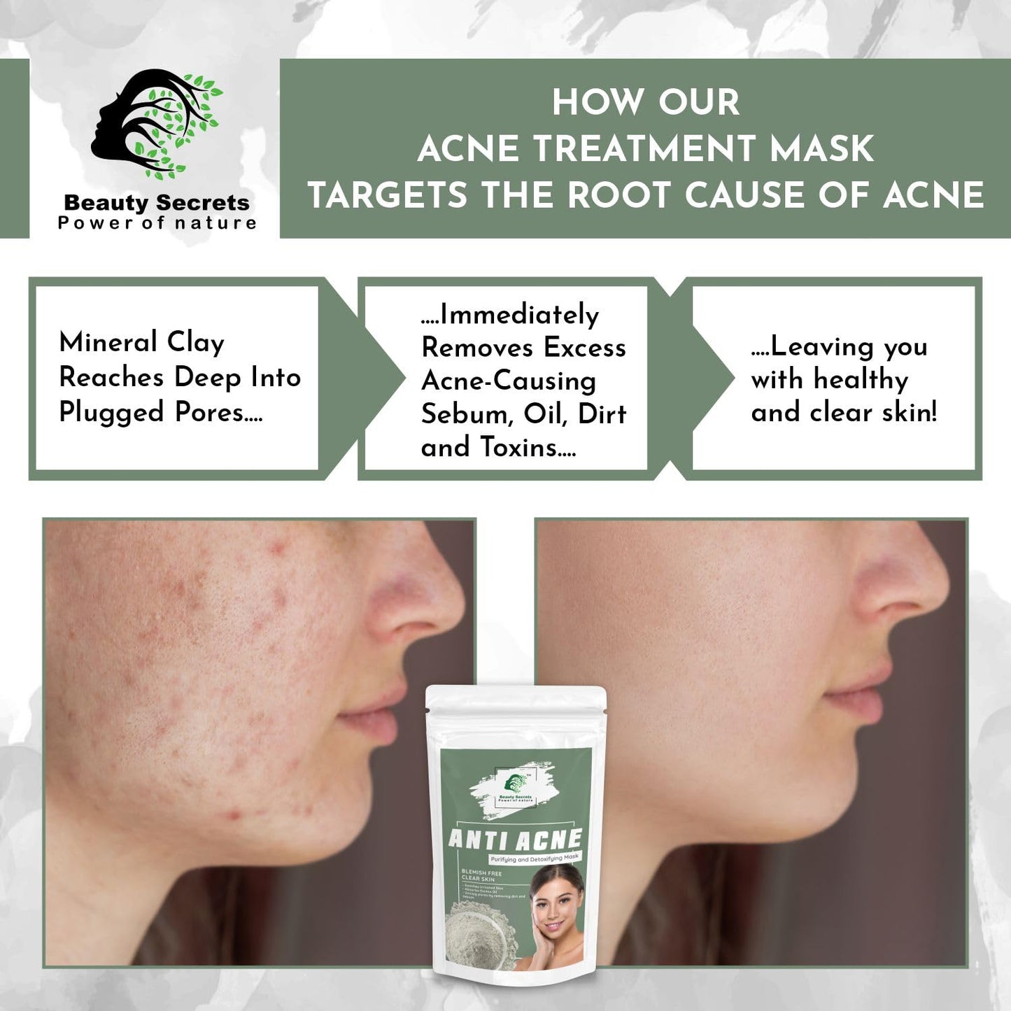 Beauty Secrets Anti Acne Face Mask - 50gm