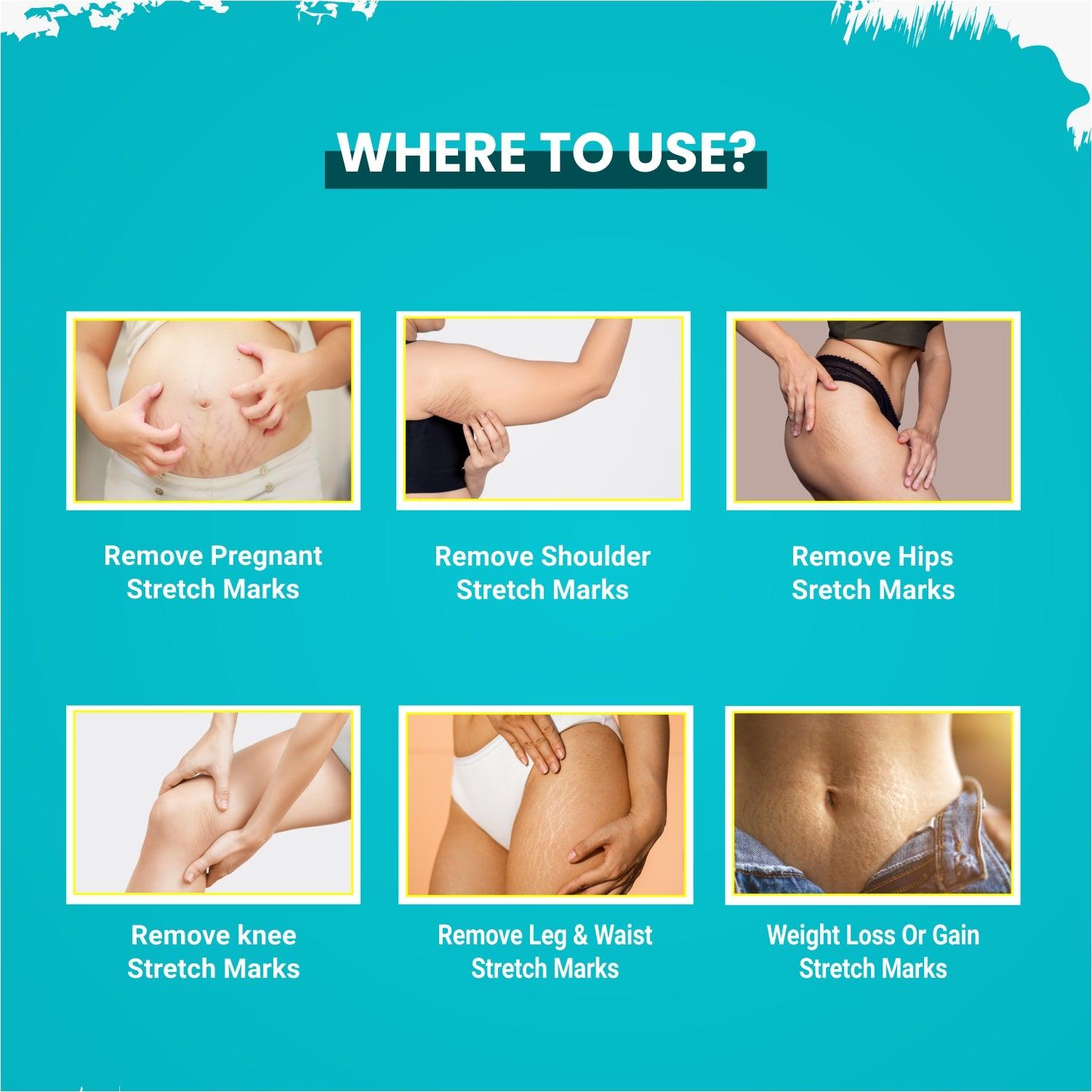 Gynocup Stretch Mark Removal Oil