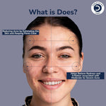 Dermistry Pure 2% Salicyclic Acid 2% Zinc PCA Acne Face Serum