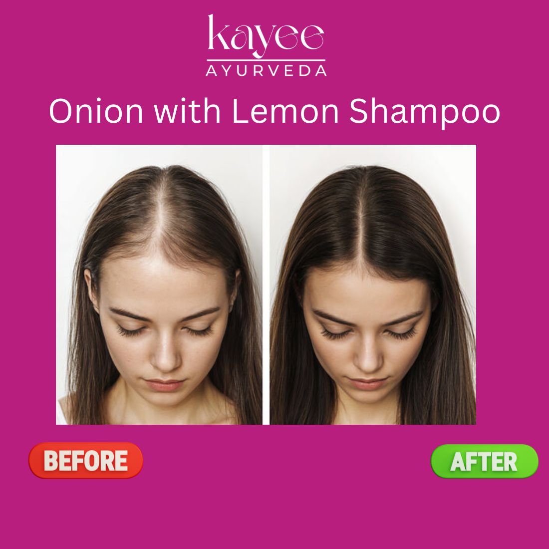 Kayee Ayurveda Onion With Lemon Shampoo for Hair Growth & Hair Fall Care | Herbal Hair Shampoo with Onion & Lemon for Scalp Cleansing, Hair Nourishment, Oil Control, Freshness, Smoothness & Natural Shine | 210 ml