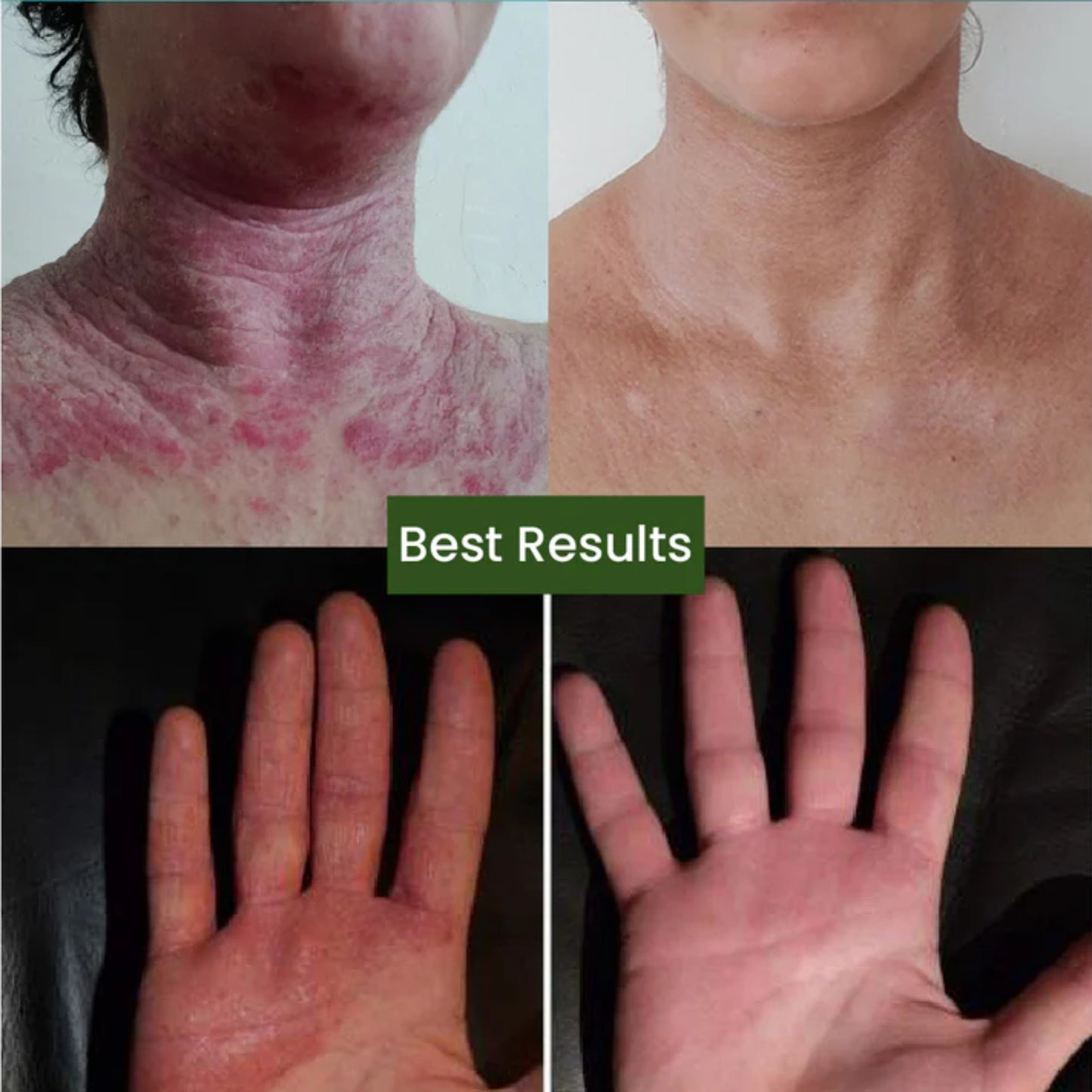 Cipzer Eczema Total Skin Capsule - 60 Capsule