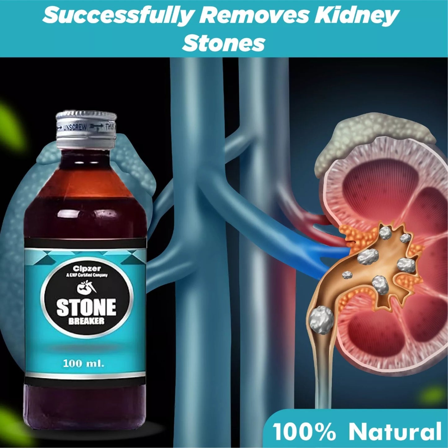 Cipzer Stone Breaker Syrup - 100 ML | Kidney Stone Relief, Urinary Tract Cleanser & Bladder Health