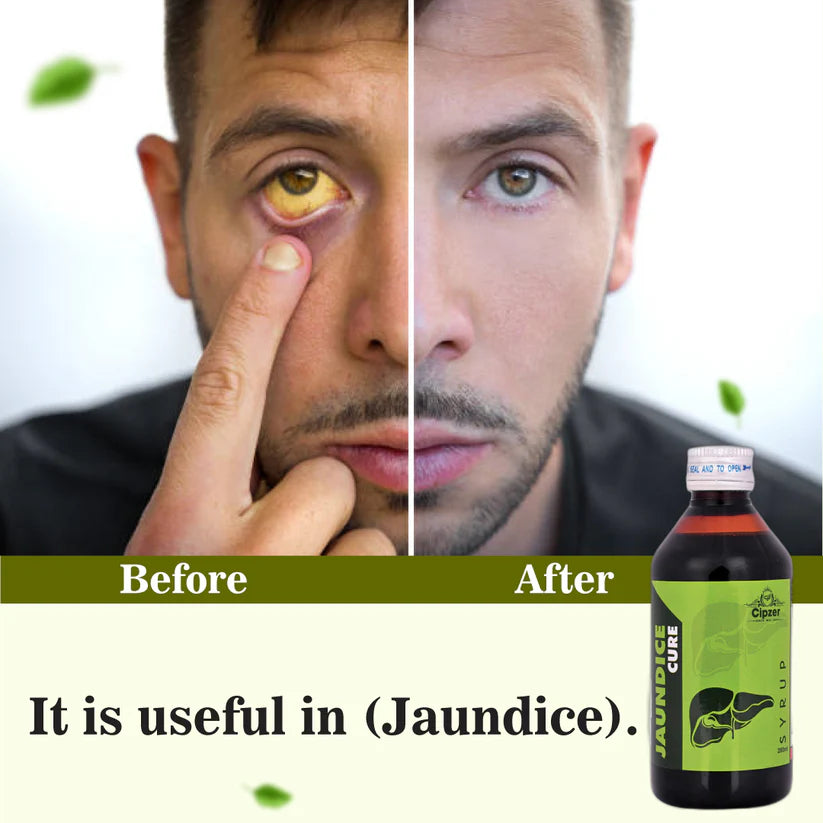 Cipzer Jaundice Cure Syrup - 200ml | Herbal Liver Tonic for Jaundice, Detox & Healthy Liver Function